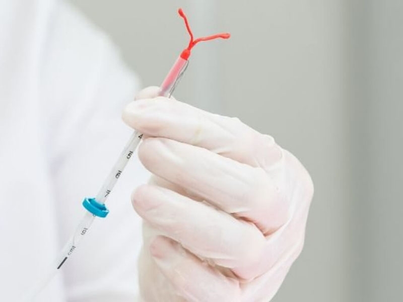 Pagtanggal ng IUD